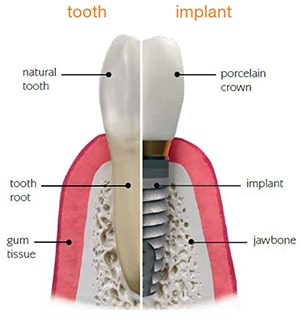 Single-tooth dental implants replace missing teeth to give you your smile and confidence back