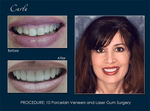 Dr. Pape performs laser treatment for gums to correct a gummy smile and improve self-confidence