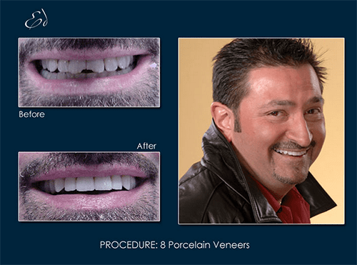 Ed received a brand-new smile with Orland Park porcelain veneers from Dr. Richard Pape