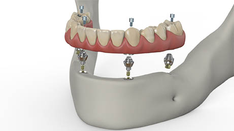 Full Arch Implants