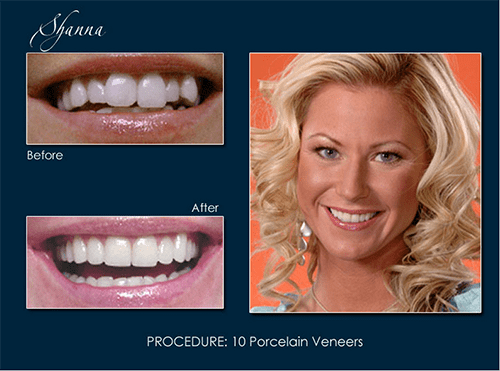 Dr. Pape uses porcelain veneers to whiten, straighten, and close gaps in patients' teeth