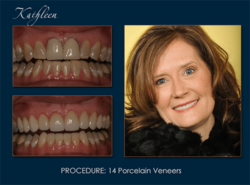 Dr. Pape gave Kathleen a new smile with porcelain veneers