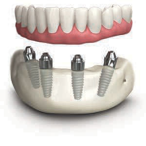 Implant Procedure