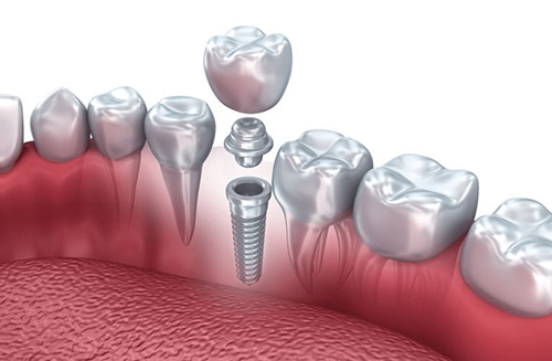 Dr. Pape and his team offer dental implants at our Orland Park dental clinic to restore your mouth back to full form and function