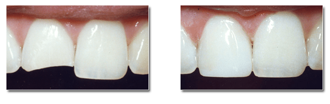Dental bonding corrects chipped teeth, gaps between teeth, and tooth discoloration.