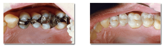 Dental inlays and onlays can restore teeth damaged by decay or wear