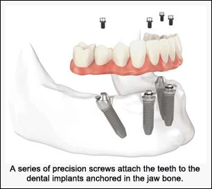 All-on-4 same-day dental implants replace missing teeth to restore your smile to its original form and function