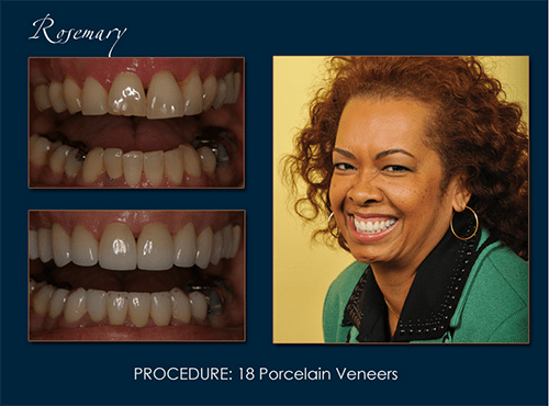 Dr. Richard Pape restored Rosemary's smile with Orland Park porcelain veneers