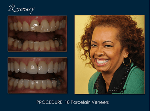 porcelain veneers