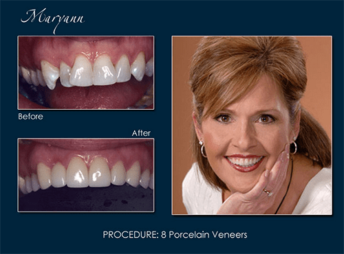 Maryann received porcelain veneers from Dr. Richard Pape